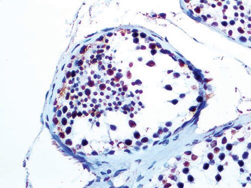 IHC of WT1 on a FFPE Testicular Cancer Tissue